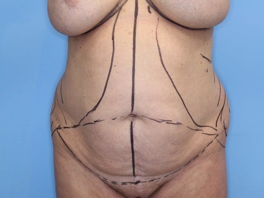 Tummy Tuck Frontal View Before