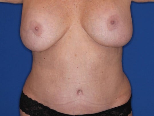 Tummy Tuck Frontal View After