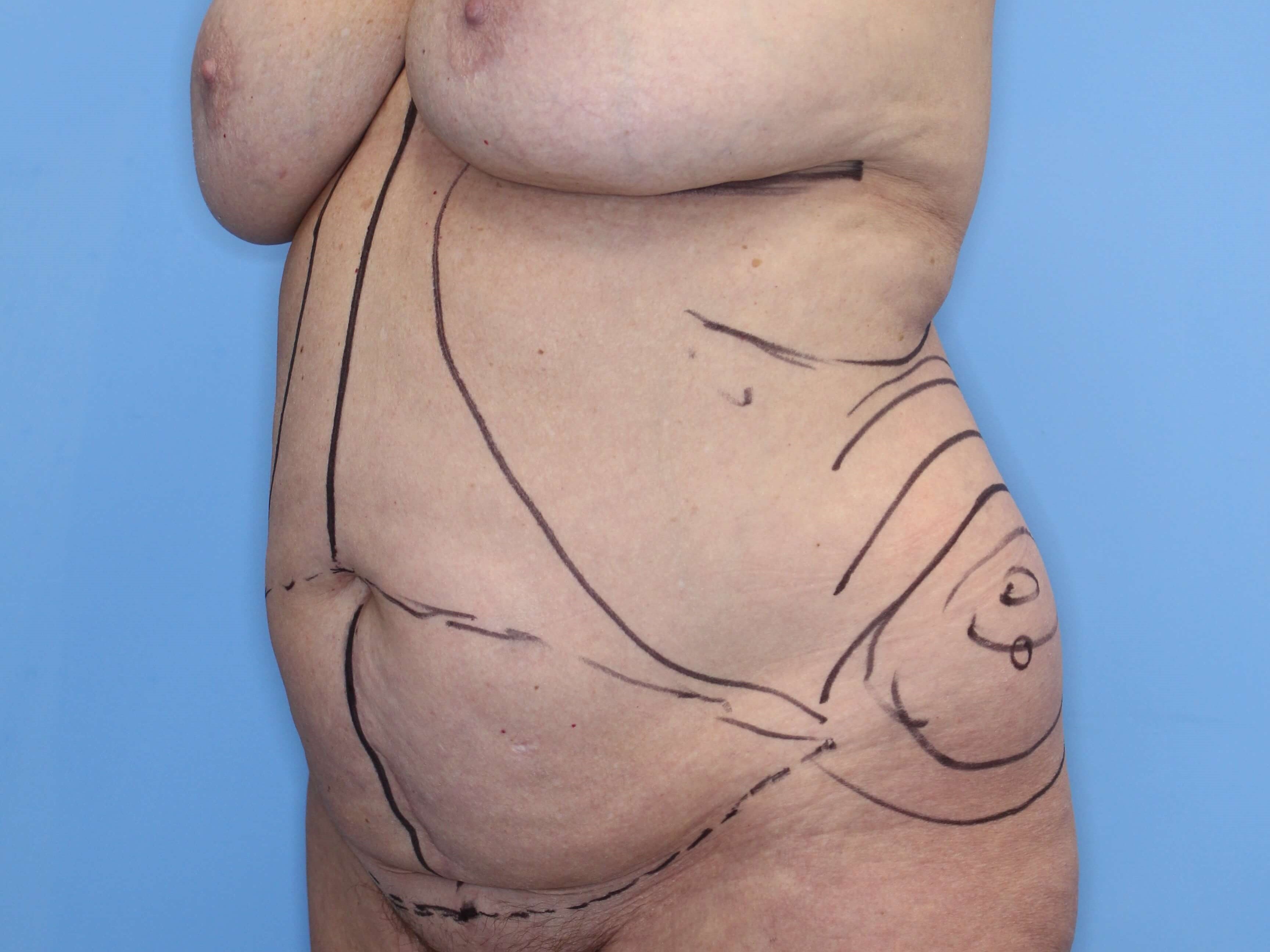 Tummy Tuck Right Oblique Before