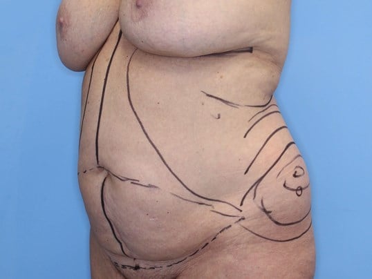 Tummy Tuck Right Oblique Before