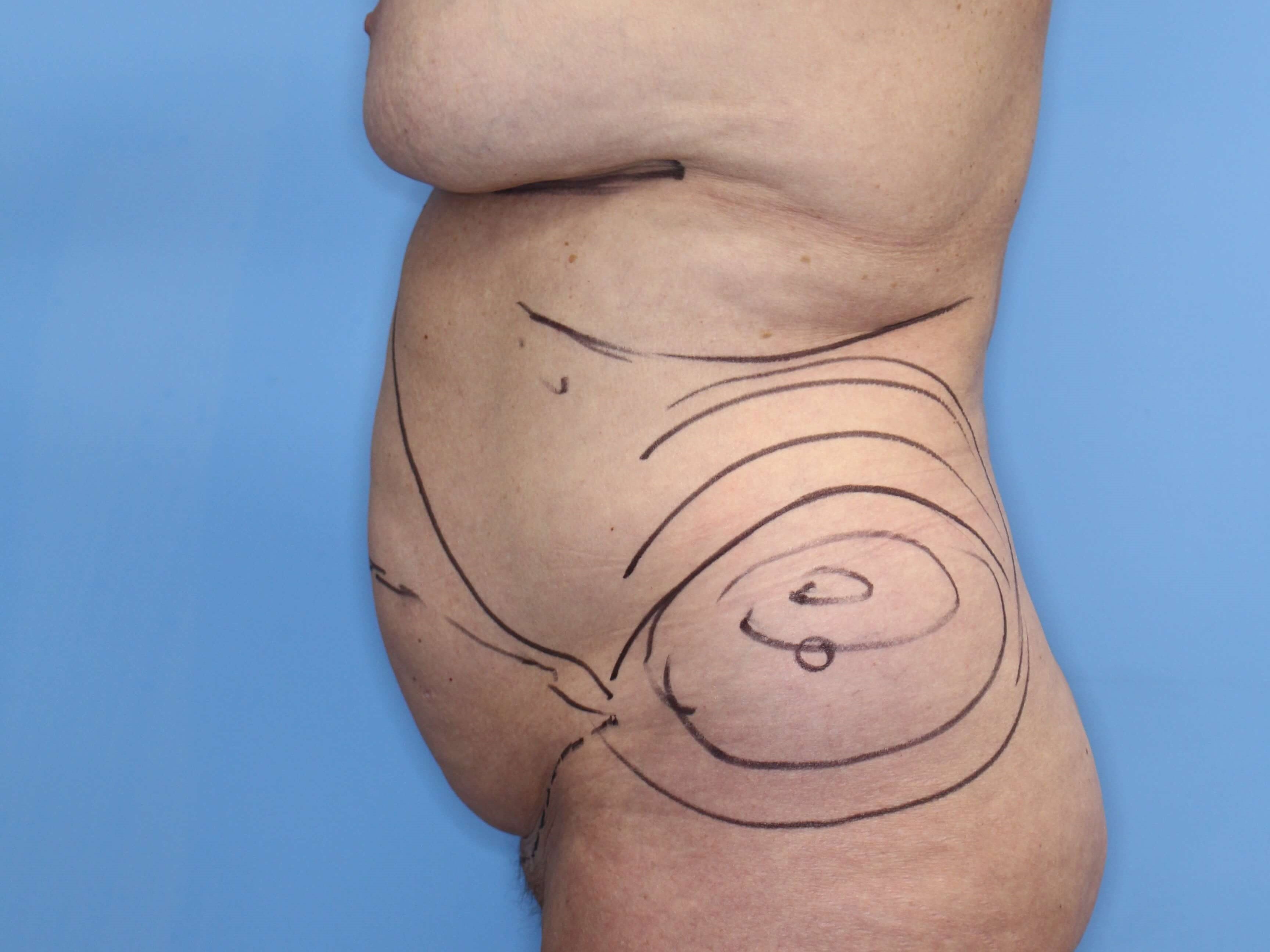 Tummy Tuck Right Lateral Before