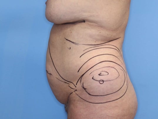 Tummy Tuck Right Lateral Before