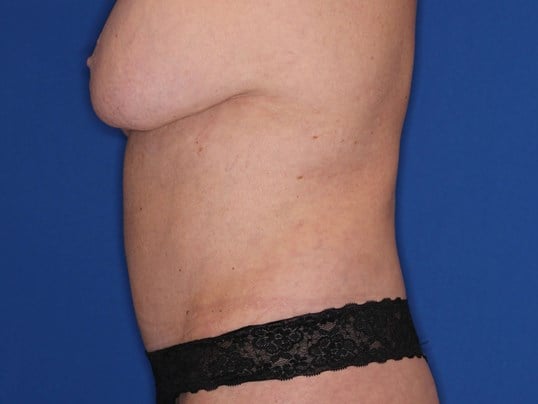 Tummy Tuck Right Lateral After