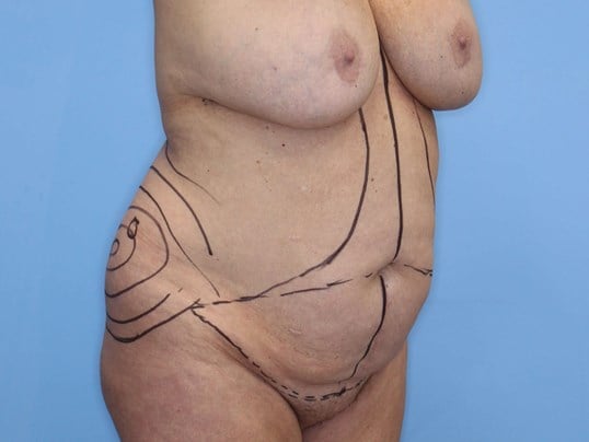 Tummy Tuck Left Oblique Before
