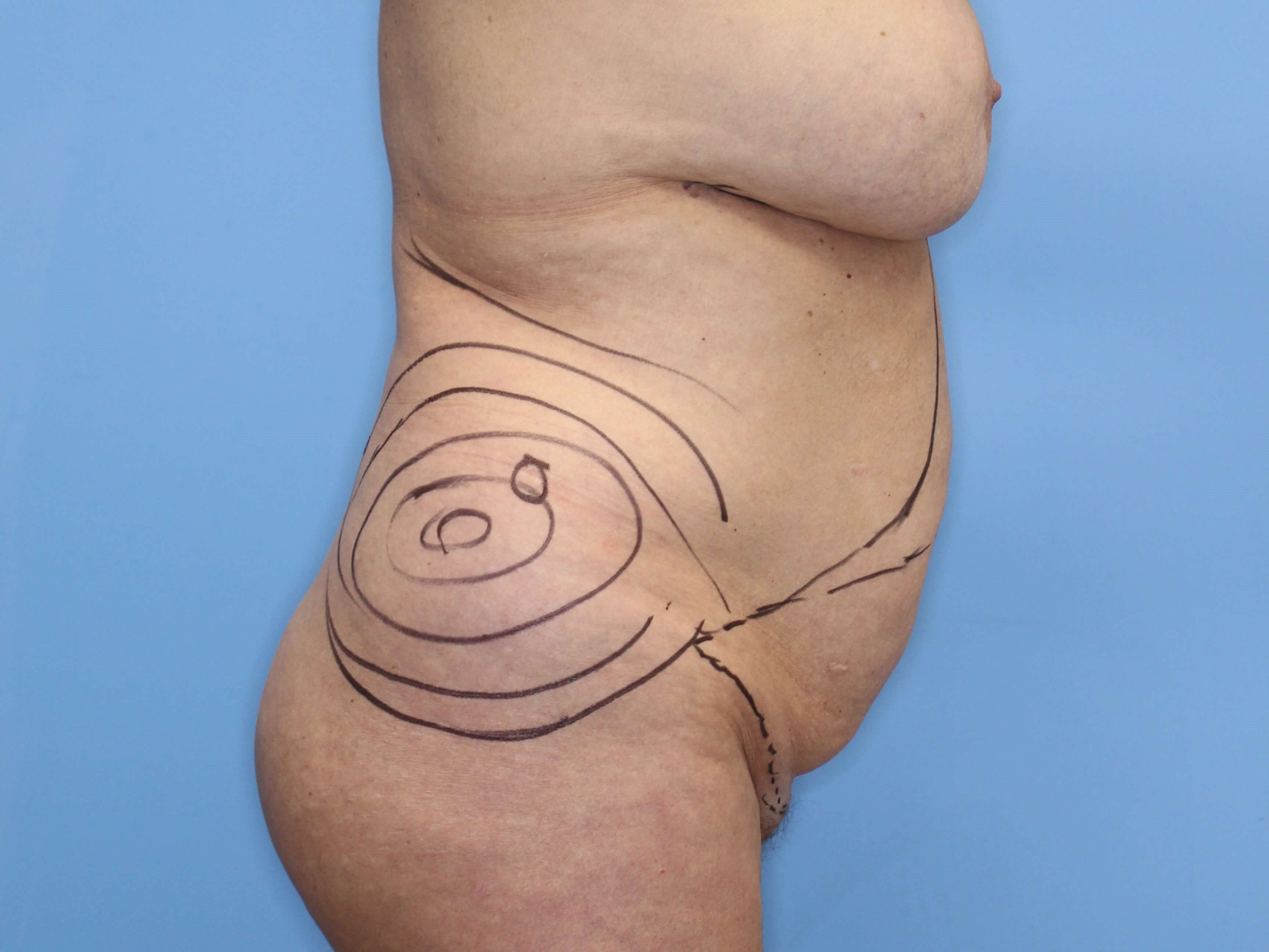 Tummy Tuck Left Lateral Before