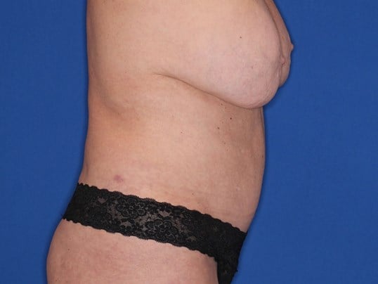 Tummy Tuck Left Lateral After