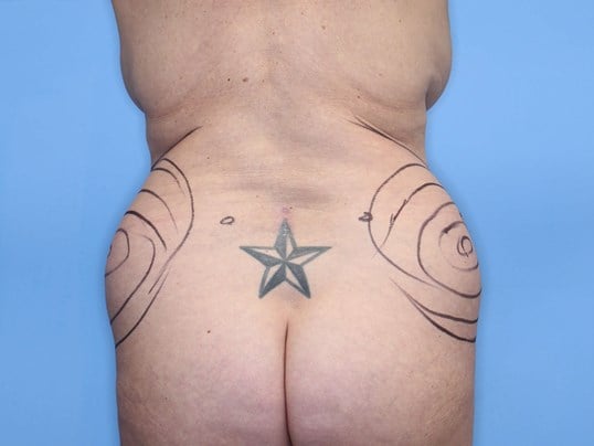 Tummy Tuck Back Before
