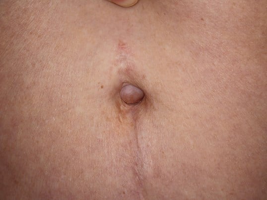 Belly Button Before