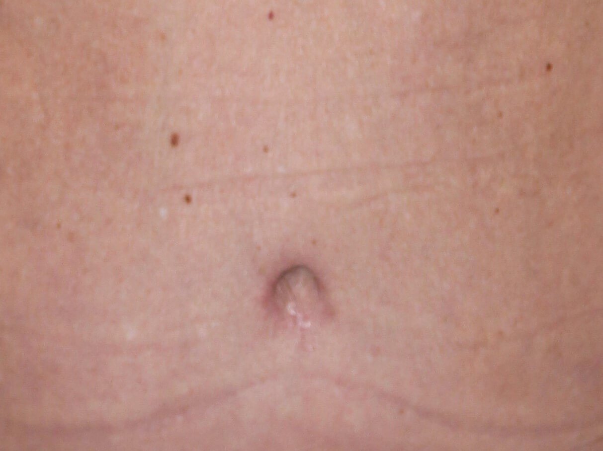 Belly Button After
