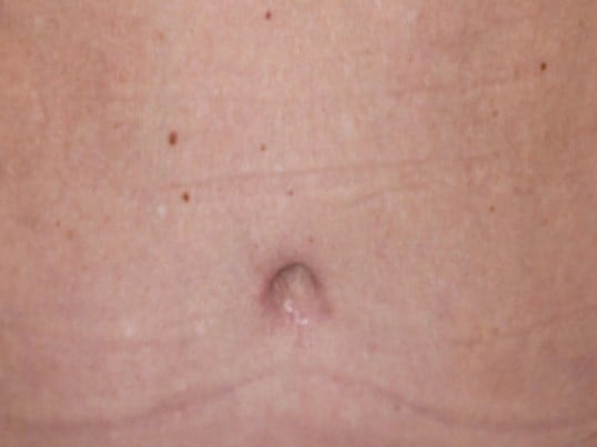 Belly Button After