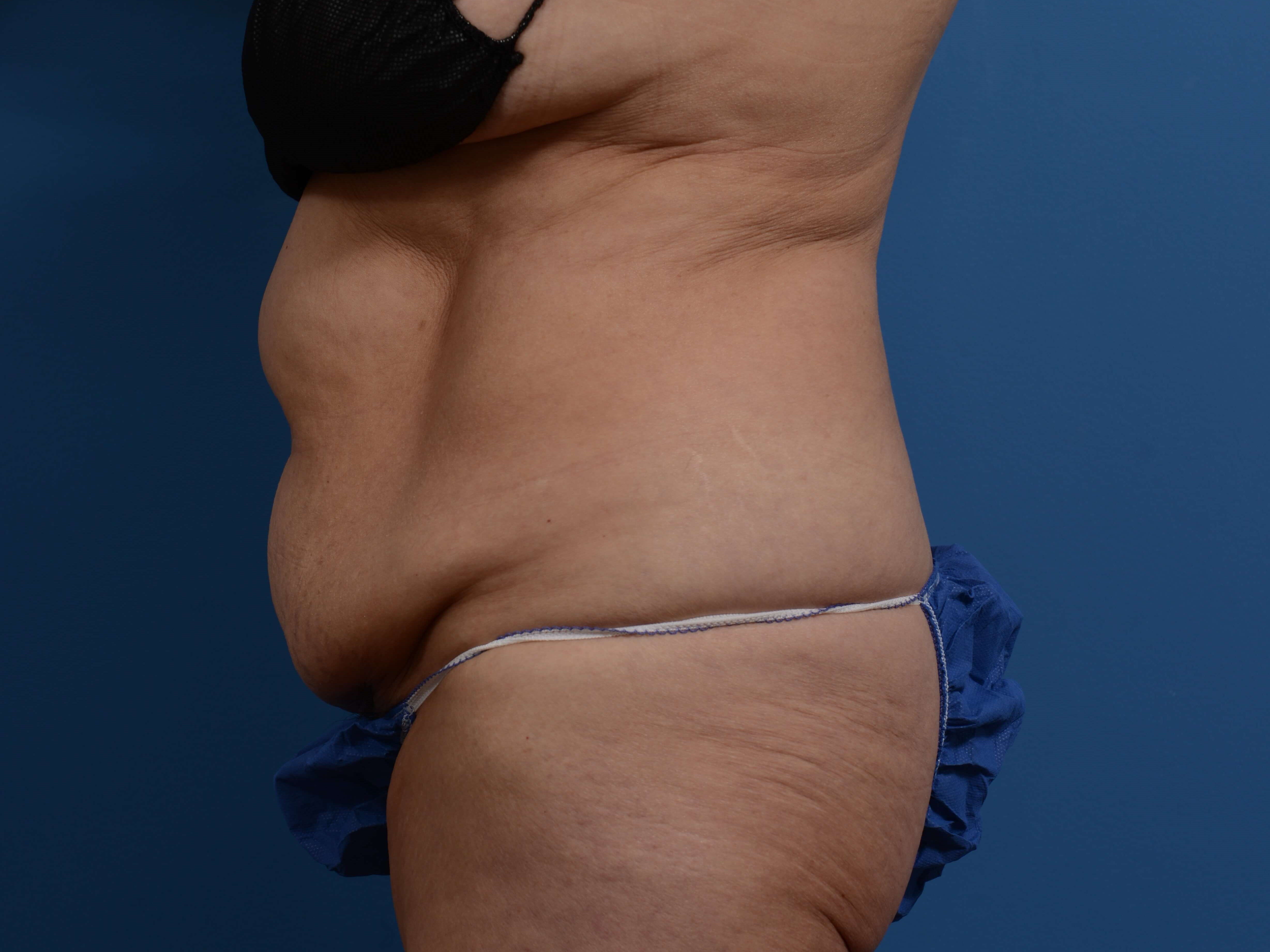 Right Lateral Before