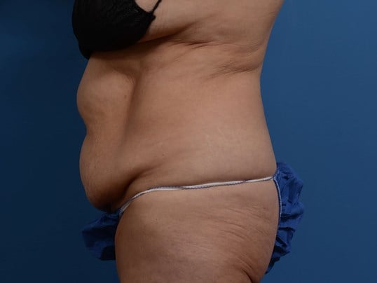 Right Lateral Before