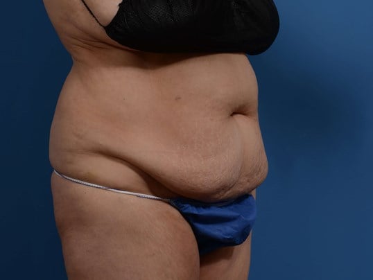 Right Oblique Before