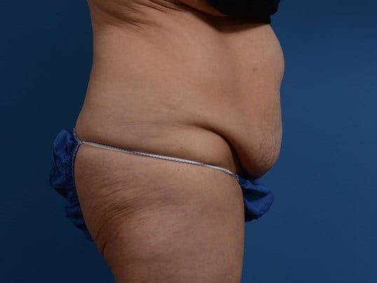 Right Lateral Before