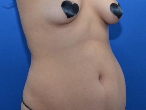 Right Oblique Before