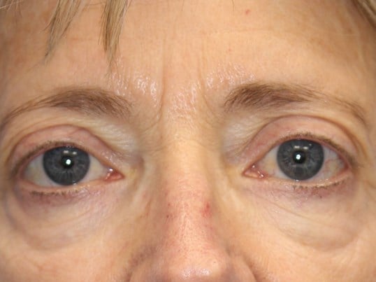 Fat injection to lower eyelids Before