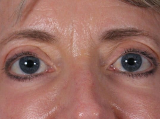 Fat injection to lower eyelids After
