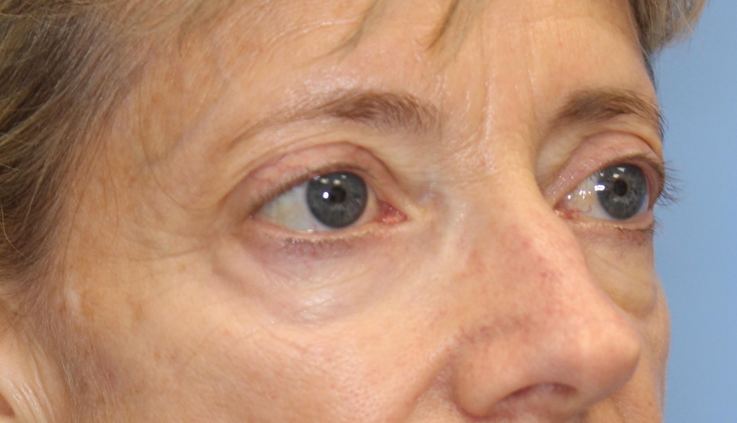 Fat injection to lower eyelids Before