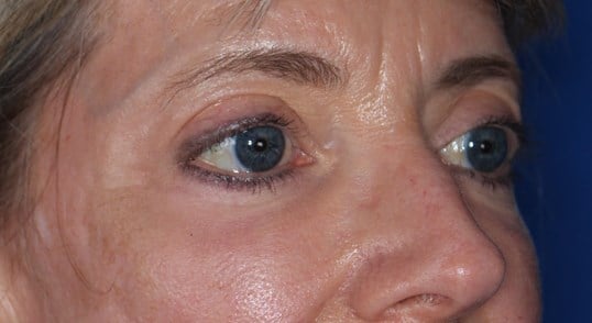Fat injection to lower eyelids After
