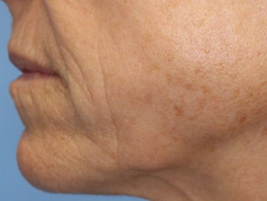 3 month post fat inj to lips Before