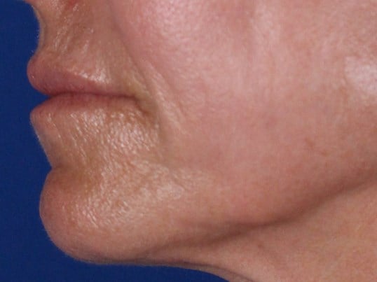 3 month post fat inj to lips After