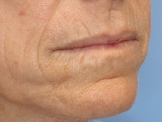 3  month post fat inj to lips Before