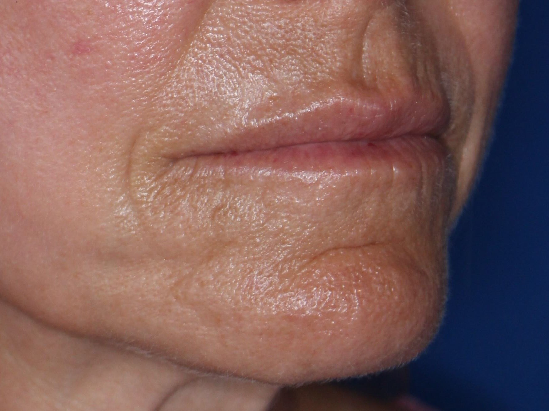 3  month post fat inj to lips After