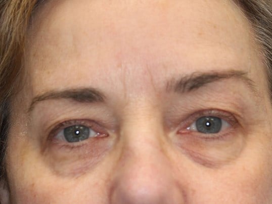 Upper & Lower Eyelid Lift Before