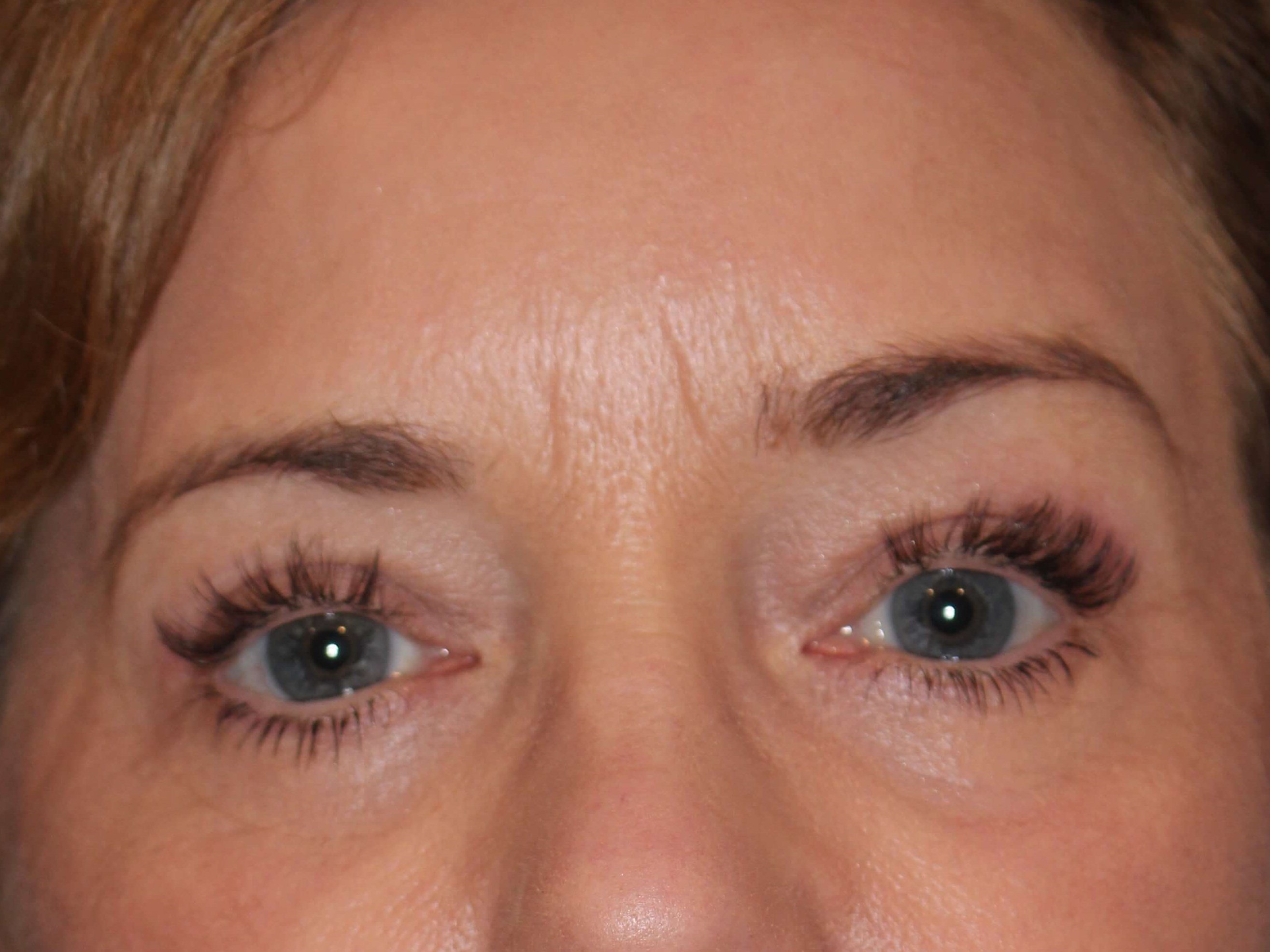Upper & Lower Eyelid Lift After