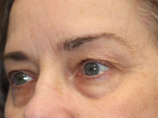 Upper & Lower Eyelid Lift Before