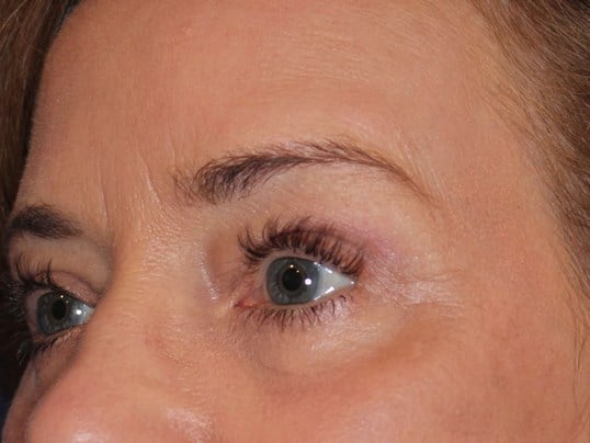 Upper & Lower Eyelid Lift After