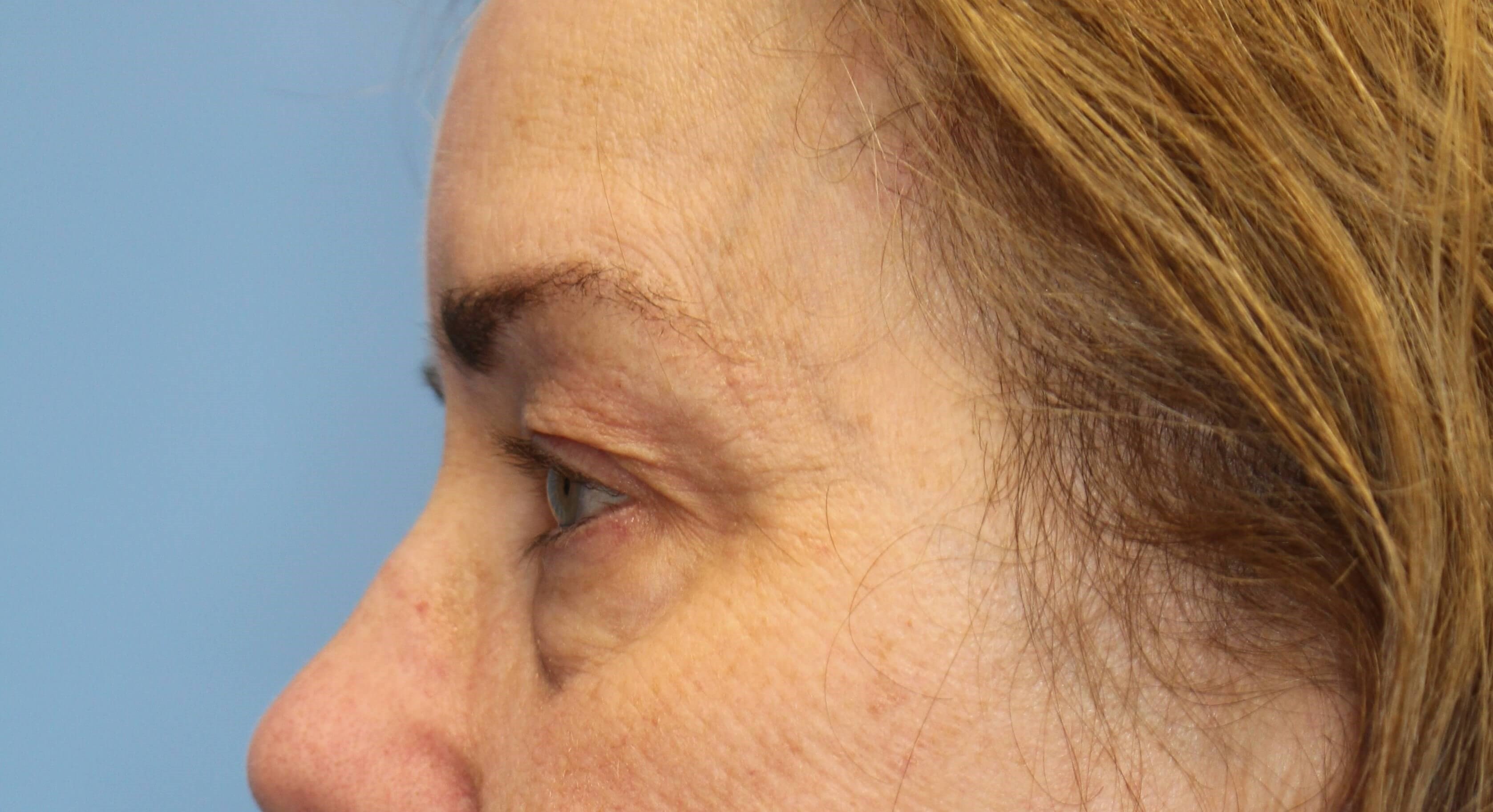 Upper & Lower Eyelid Lift Before