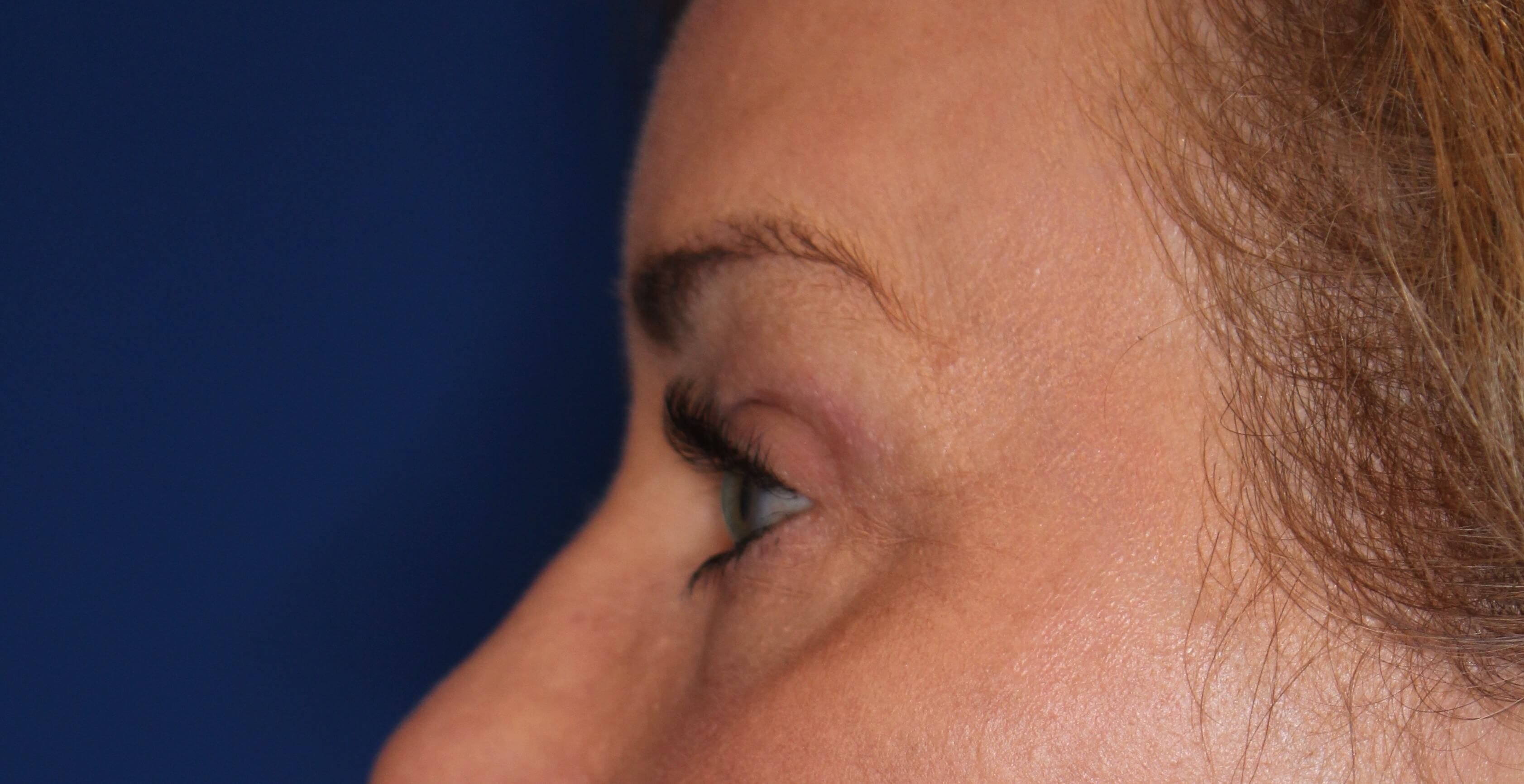 Upper & Lower Eyelid Lift After