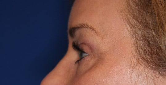 Upper & Lower Eyelid Lift After