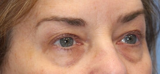 Upper & Lower Eyelid Lift Before