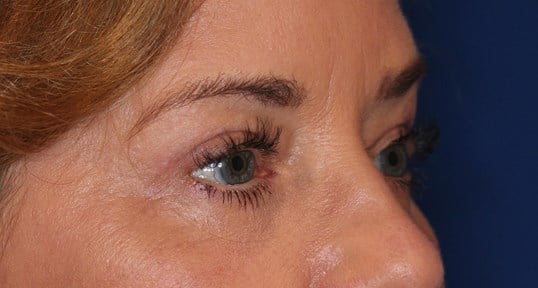 Upper & Lower Eyelid Lift After
