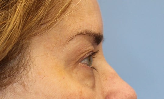 Upper & Lower Eyelid Lift Before