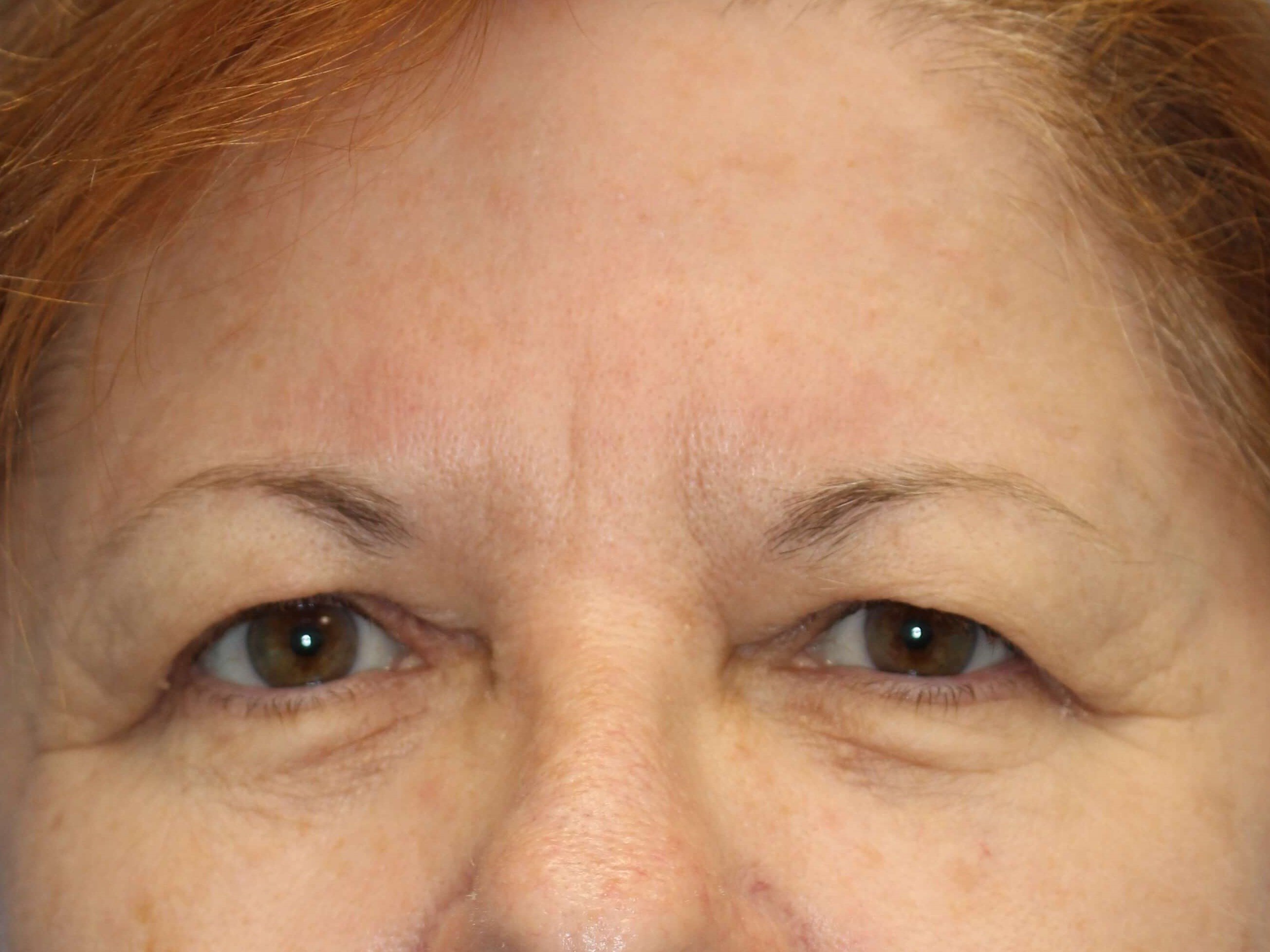 Upper Eyelid Lift Before