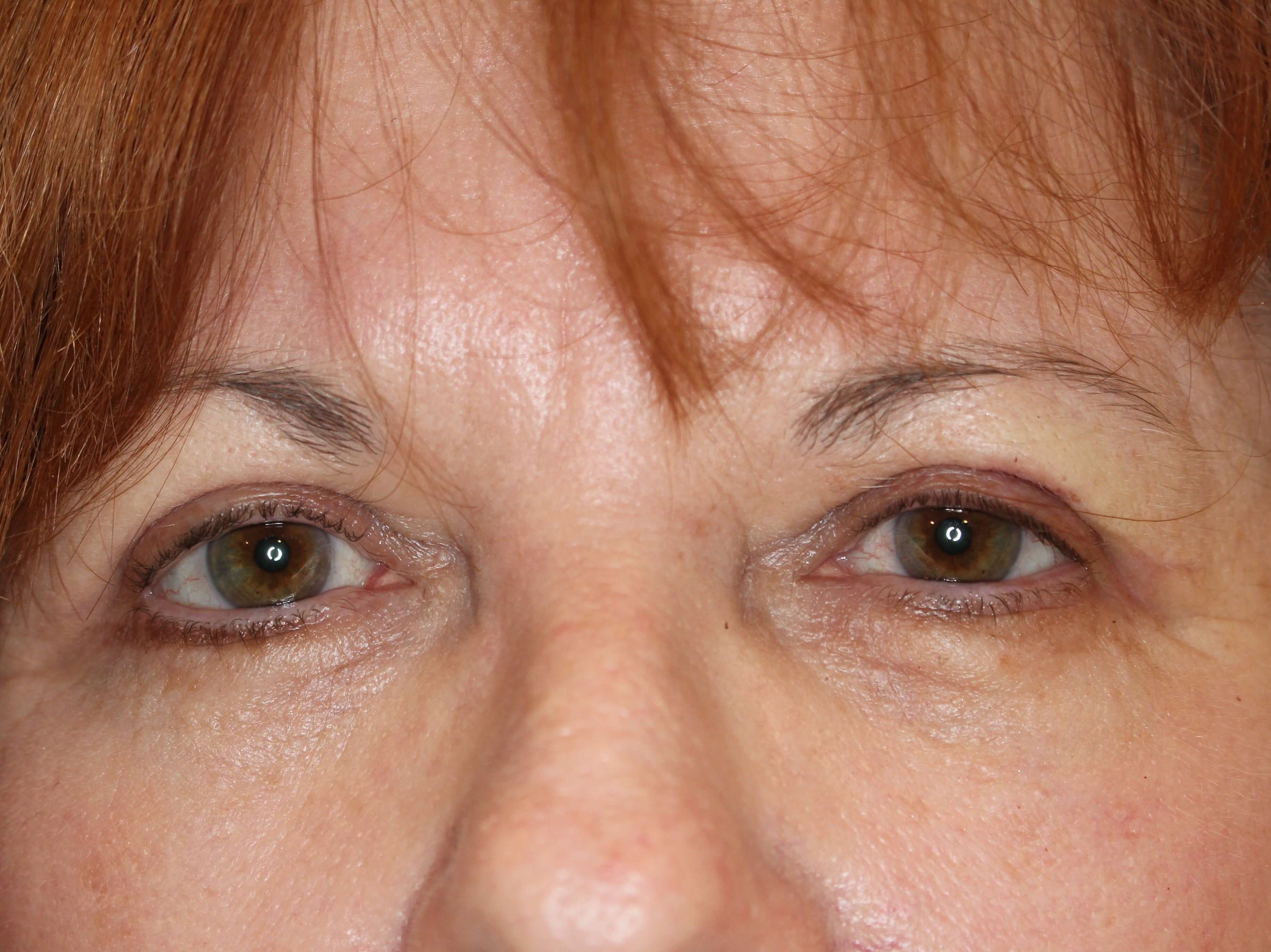 Upper Eyelid Lift After