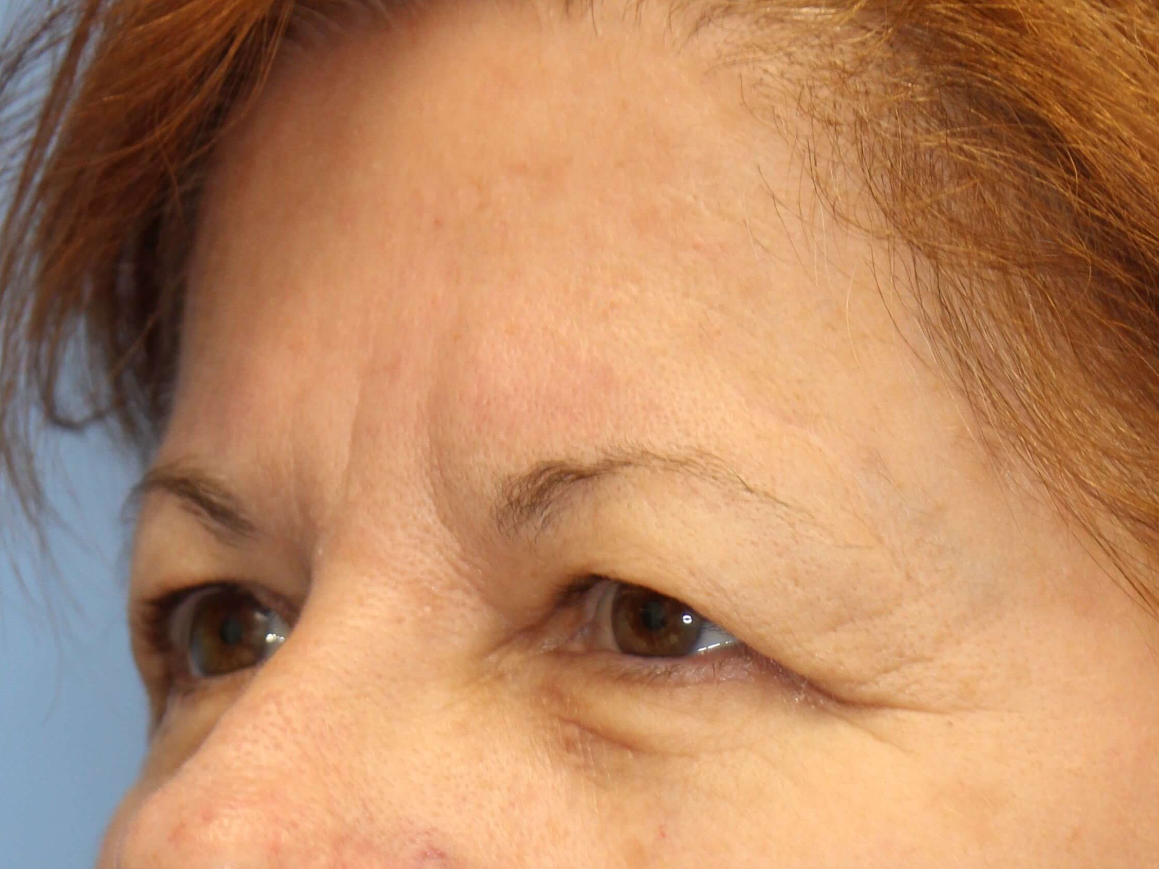 Upper Eyelid Lift Before