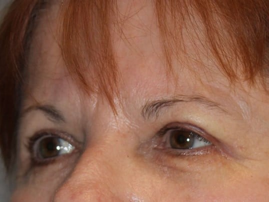 Upper Eyelid Lift After