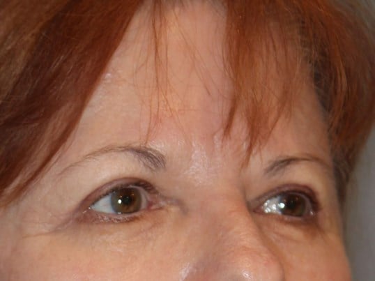 Upper Eyelid Lift After