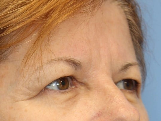 Upper Eyelid Lift Before