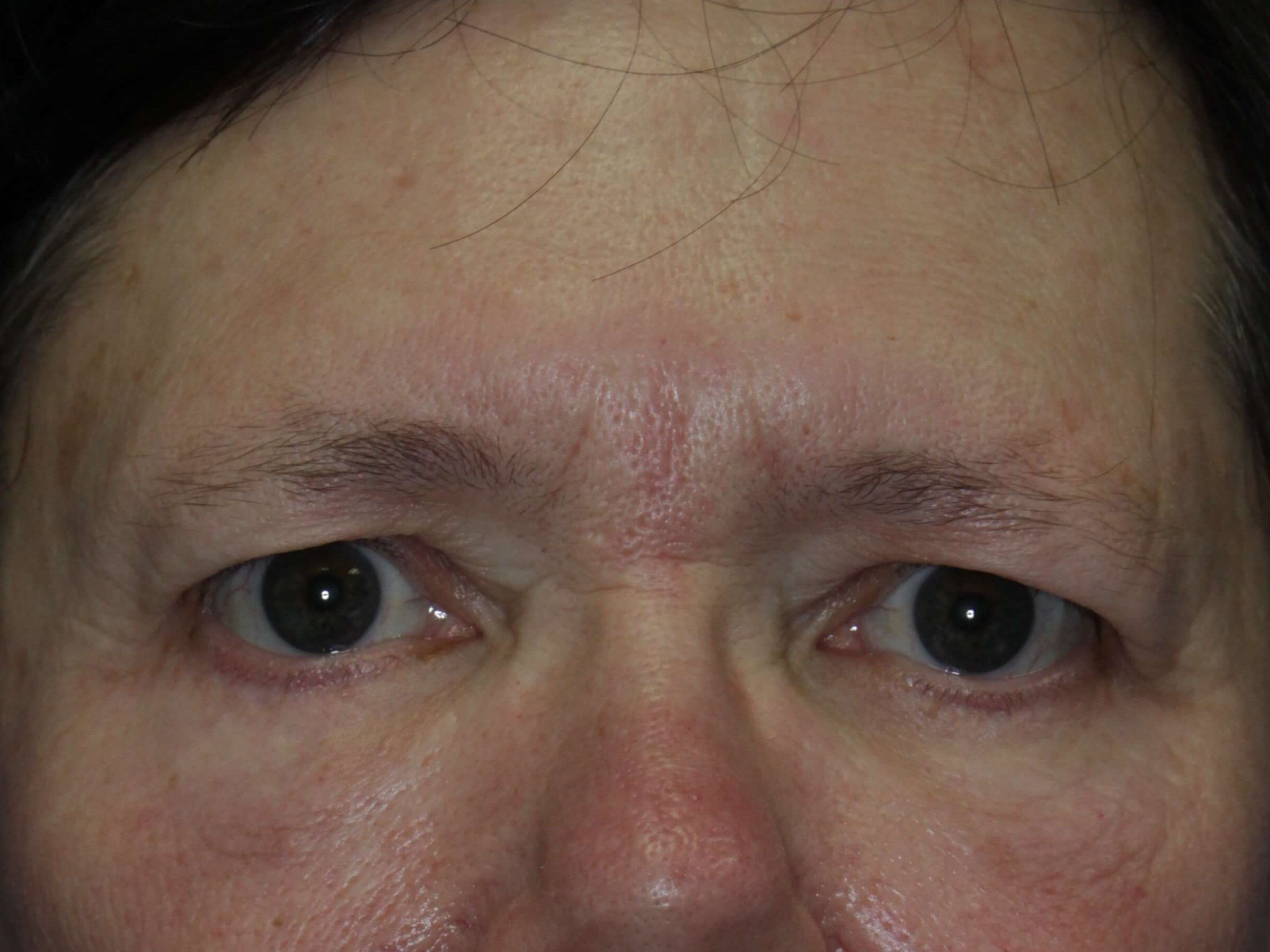 Lower Eyelid Lift After