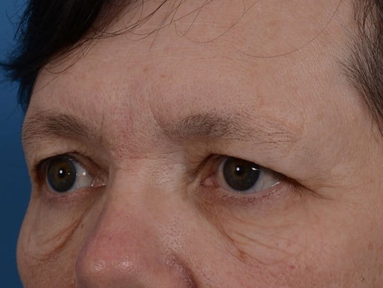 Lower Eyelid Lift Before