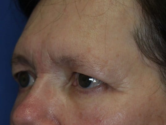 Lower Eyelid Lift After