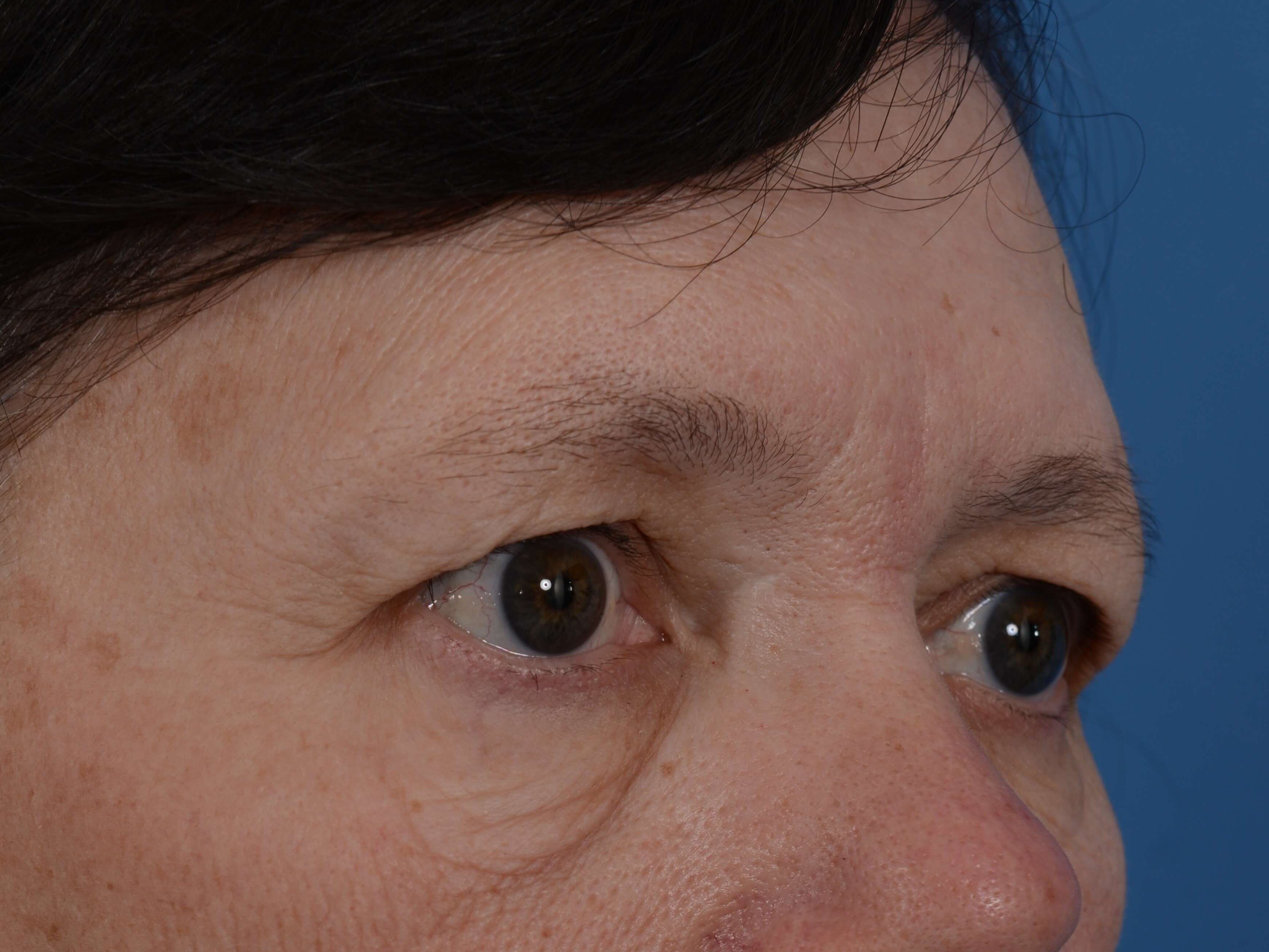Lower Eyelid Lift Before
