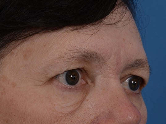 Lower Eyelid Lift Before