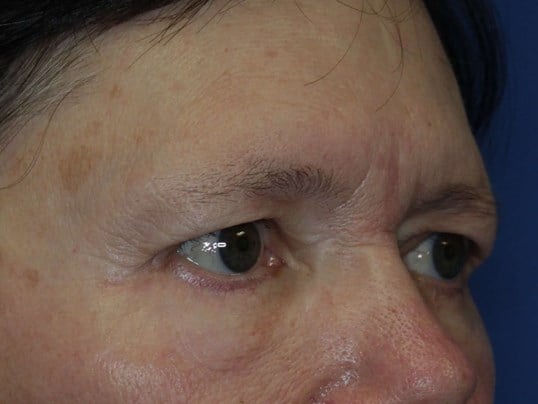 Lower Eyelid Lift After