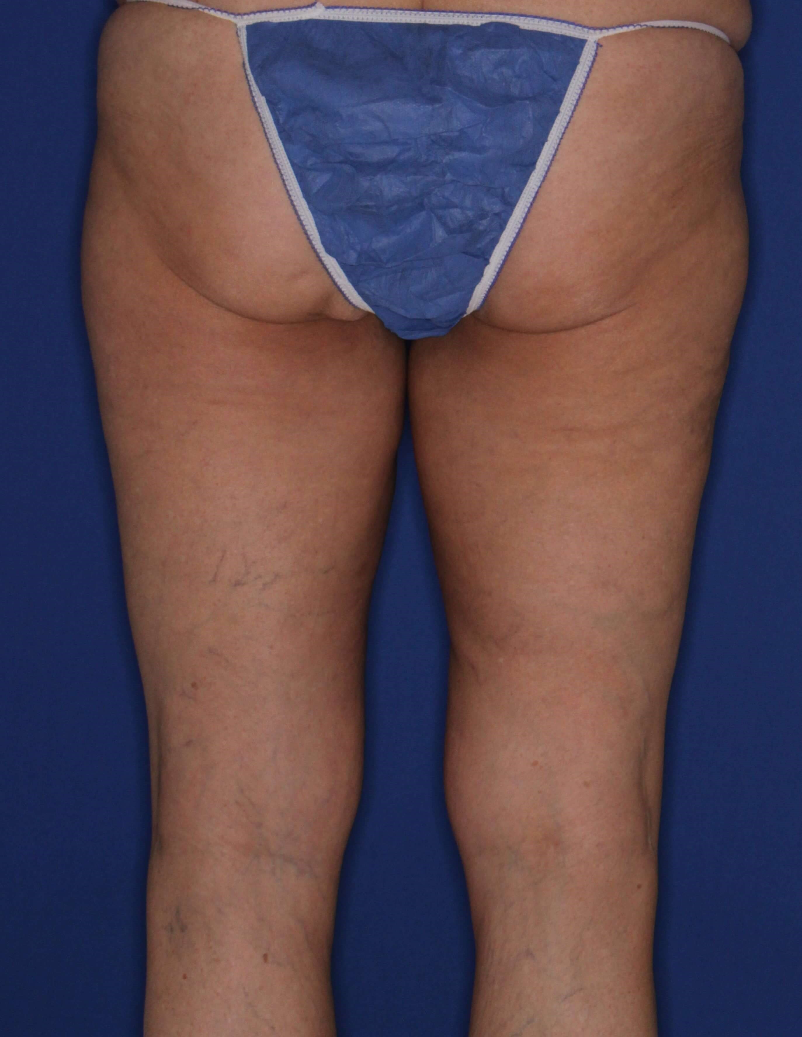 Outer & Inner Thighs Before